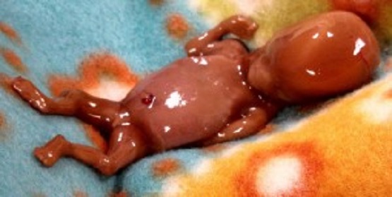 Amazing Photos of Nathan, Miscarried at 14 Weeks, Show Unborn Baby's ...