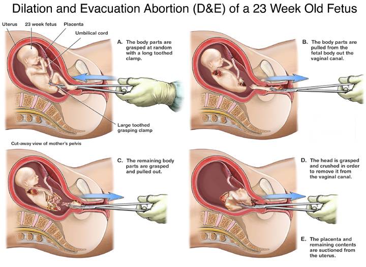 Dismemberment Abortion