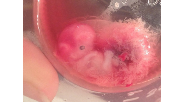 Mothers Photos Of Her Miscarried Baby At 7 Weeks Reveal The Humanity
