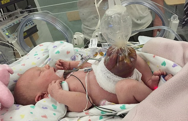 Girl Born “inside Out” Has Life Saving Surgery Minutes After Birth Her Organs Were Outside Her