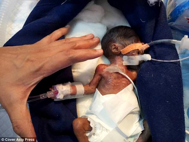 Baby Born Alive After Abortion Was Thrown in the Trash, Pro-Abortion Snopes Tries to Hide the Truth