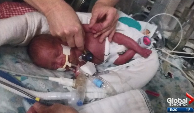 24 week old premature baby