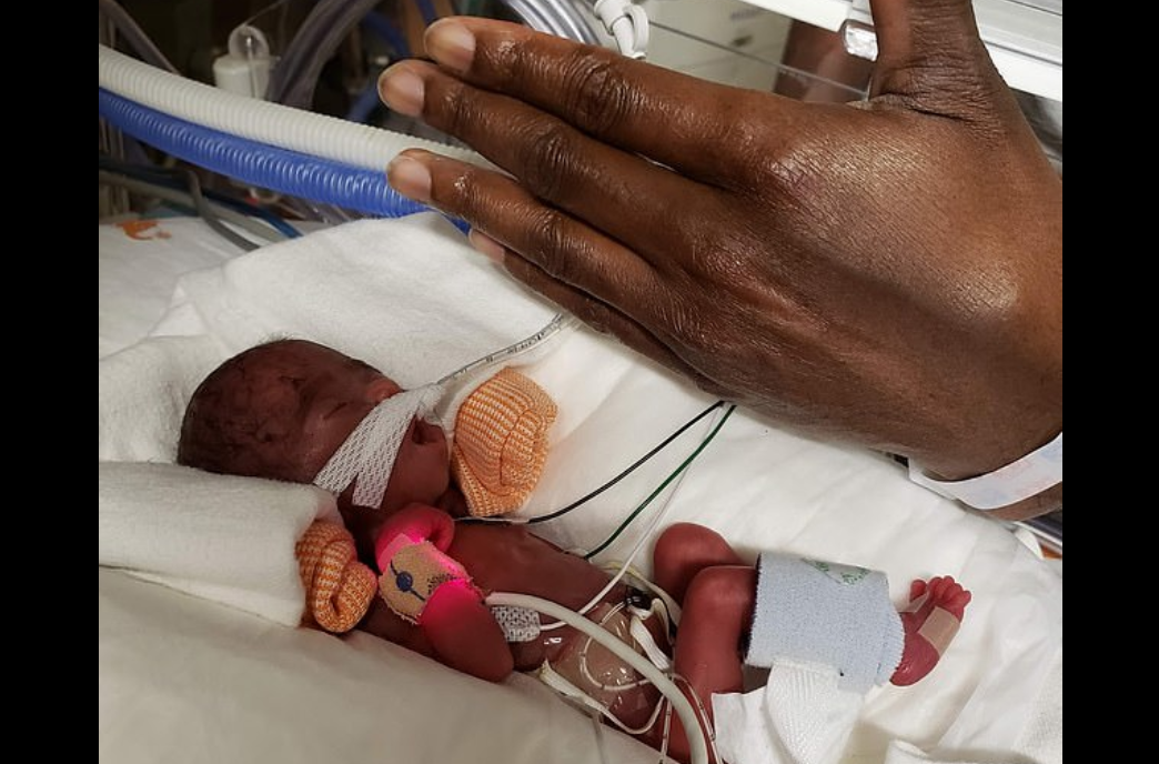 24 Week Old Premature Baby Weighing Just 13 Ounces At Birth Goes Home Healthy