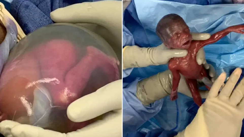 Premature Baby Girls Born At 22 Weeks Are The 2nd Youngest Ever To Survive Look At Them Now Lifenews Com