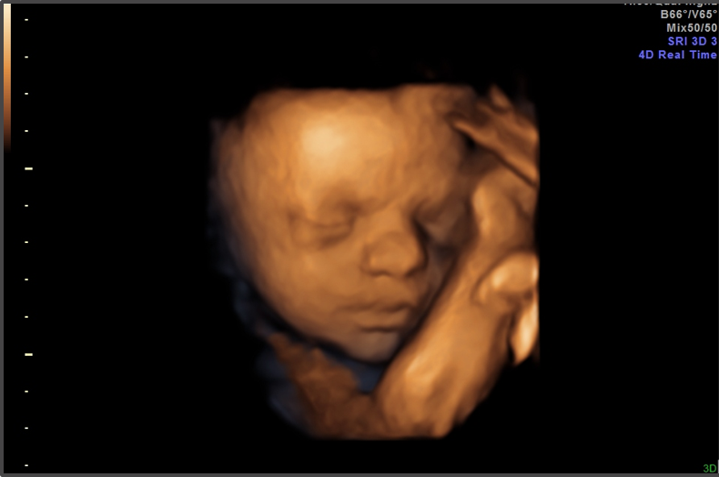 Ultrasounds Remind us That Unborn Babies are Human Beings