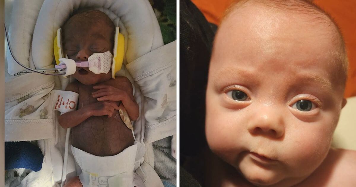 Miracle Baby Born Weighing Just 15 Ounces is Now 8 Months Old