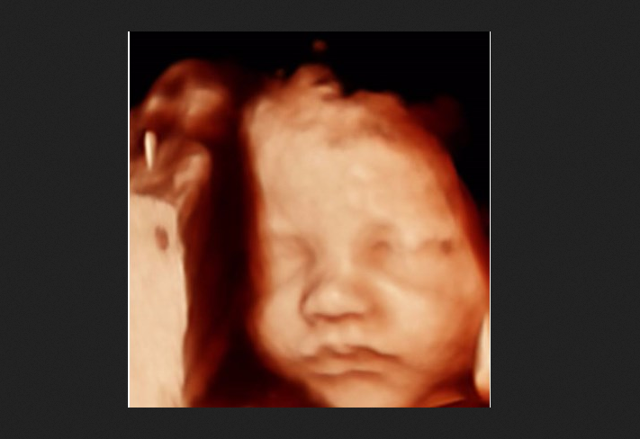 Why We Still Need to Fight Abortion Four Years After Dobbs